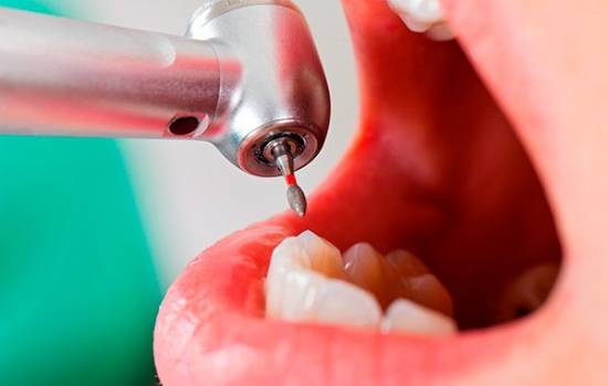 Implantes Dentales