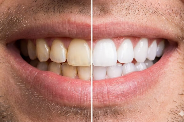 Antes y después de un blanqueamiento